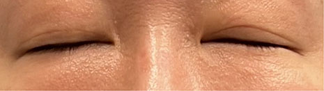 顔面神経麻痺　治療後