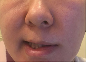 顔面神経麻痺　治療前