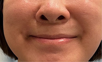 顔面神経麻痺　治療後