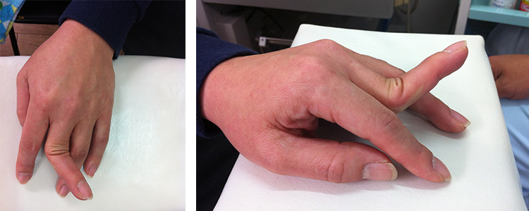 症例①　指の脱臼整復前