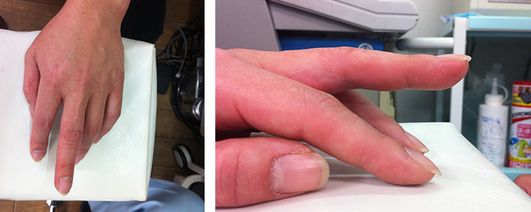 症例①　指の脱臼整復後