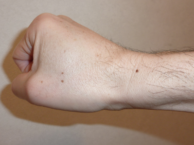 症例③　ほくろ（美容）治療前