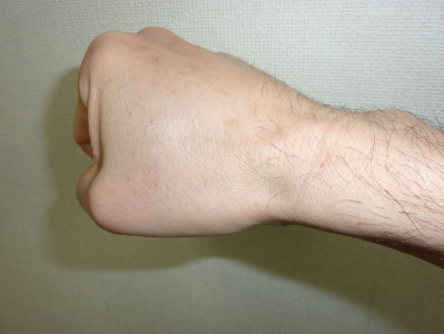 症例③　ほくろ（美容）治療後